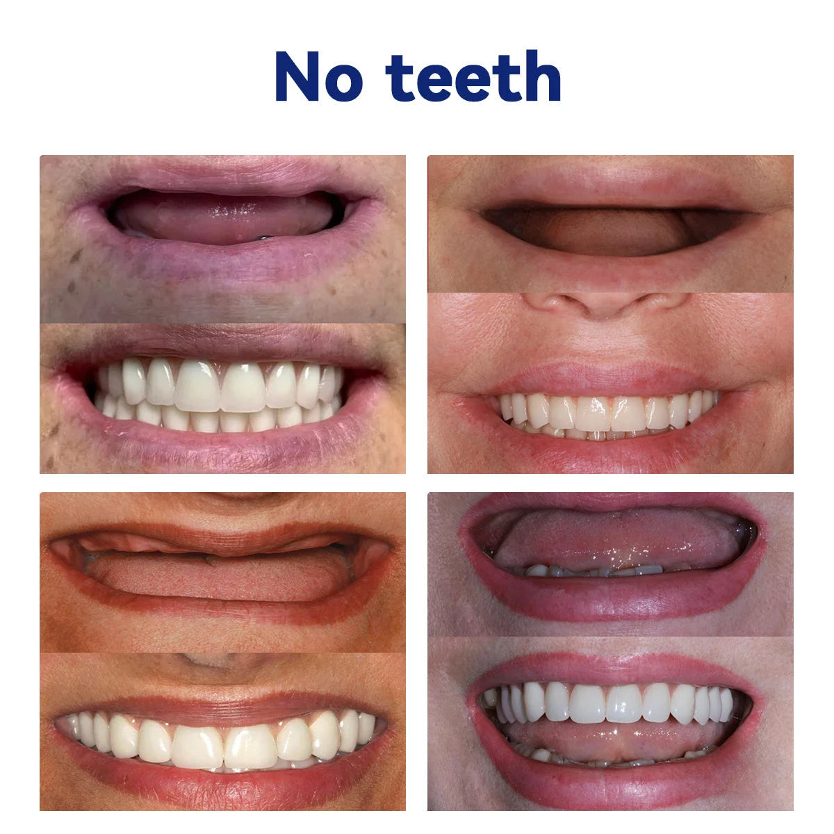 NESLEMY™-🦷Advanced Customized Full Denture Set🦷——Self-adsorbed in the mouth, comfortable to wear, worry-free chewing——your exclusive denture solution  (⏰Limited time discount last 30 minutes⏰)