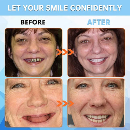NESLEMY™-🦷Advanced Customized Full Denture Set🦷——Self-adsorbed in the mouth, comfortable to wear, worry-free chewing——your exclusive denture solution  (⏰Limited time discount last 30 minutes⏰)